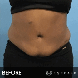 EmeraldLaser-BA-SlimContour_01a EmeraldLaser-BA-SlimContour_01a