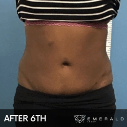 EmeraldLaser-BA-SlimContour_01b EmeraldLaser-BA-SlimContour_01b