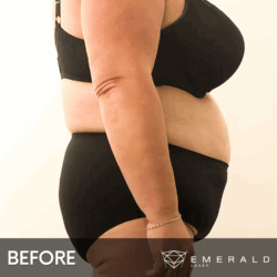 EmeraldLaser-BA-SlimContour_02a EmeraldLaser-BA-SlimContour_02a