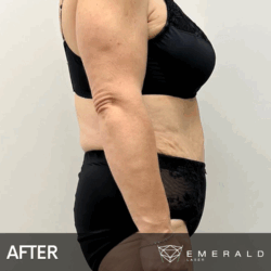 EmeraldLaser-BA-SlimContour_02b EmeraldLaser-BA-SlimContour_02b