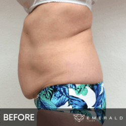 EmeraldLaser-BA-SlimContour_03a EmeraldLaser-BA-SlimContour_03a
