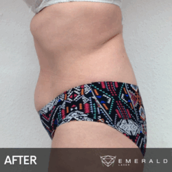 EmeraldLaser-BA-SlimContour_03b EmeraldLaser-BA-SlimContour_03b
