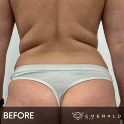 EmeraldLaser-BA-SlimContour_04a EmeraldLaser-BA-SlimContour_04a
