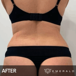 EmeraldLaser-BA-SlimContour_04b EmeraldLaser-BA-SlimContour_04b