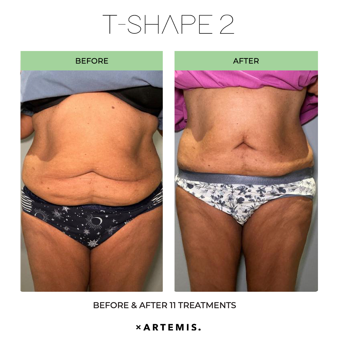 TShape2-SlimContour-02