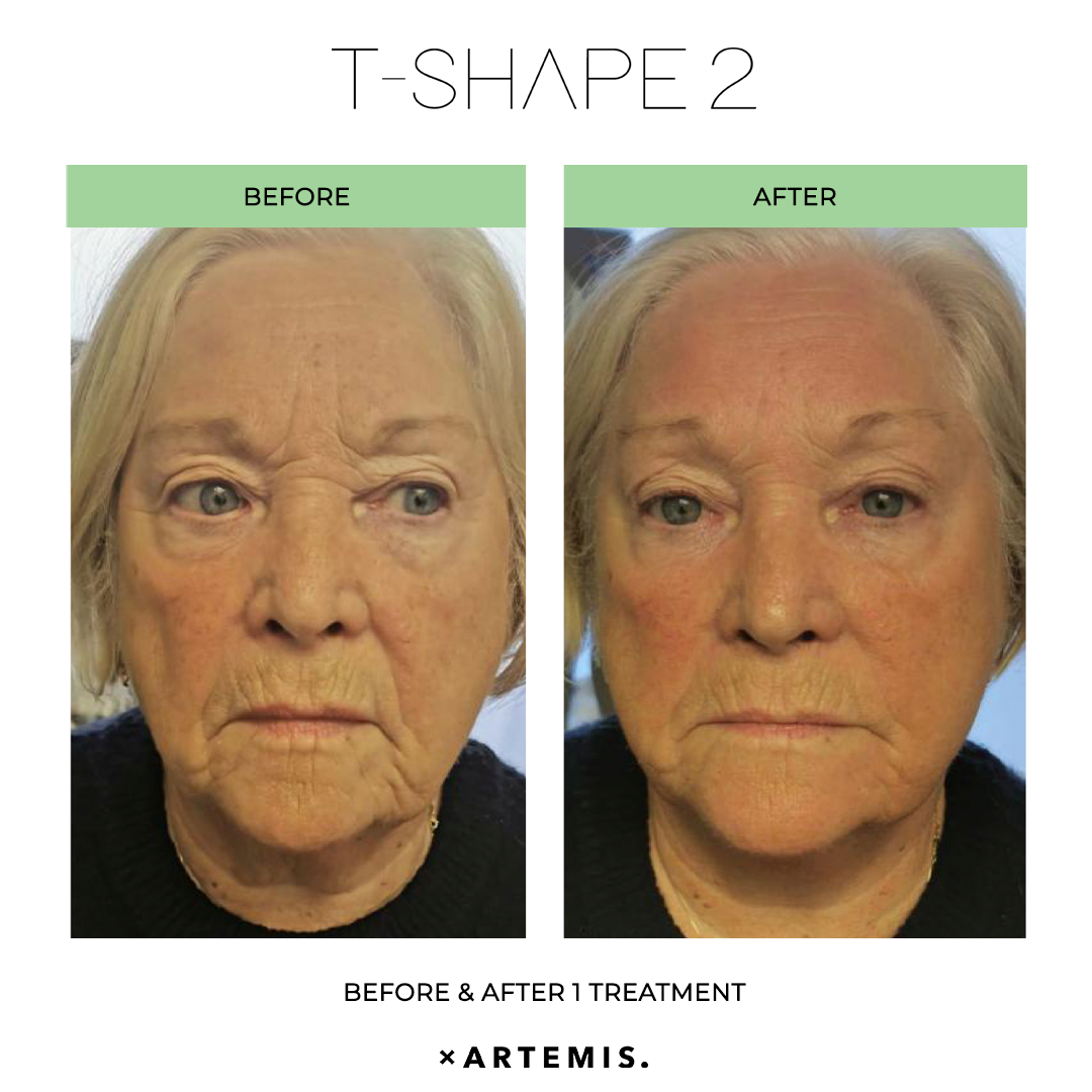 TShape2-SlimContour-03