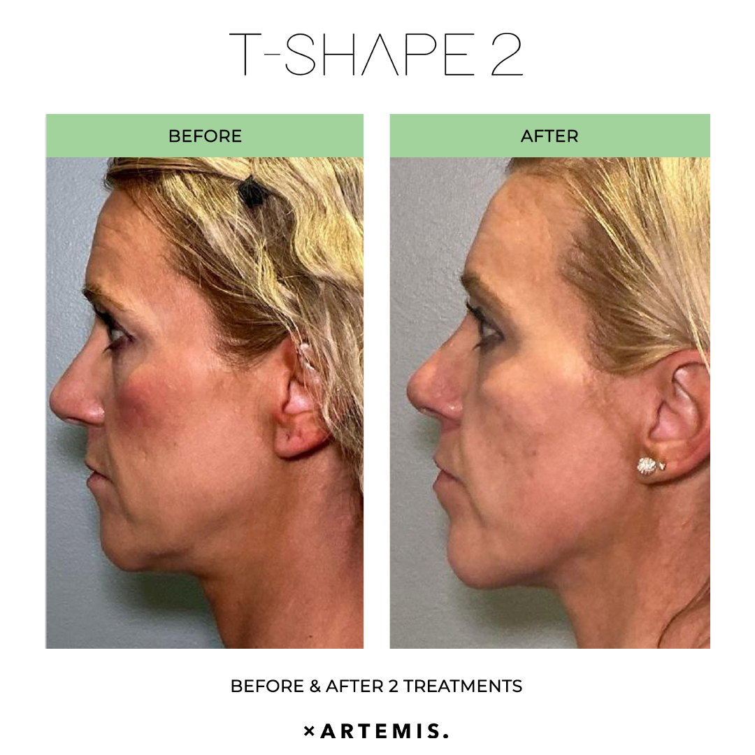 TShape2-SlimContour-04