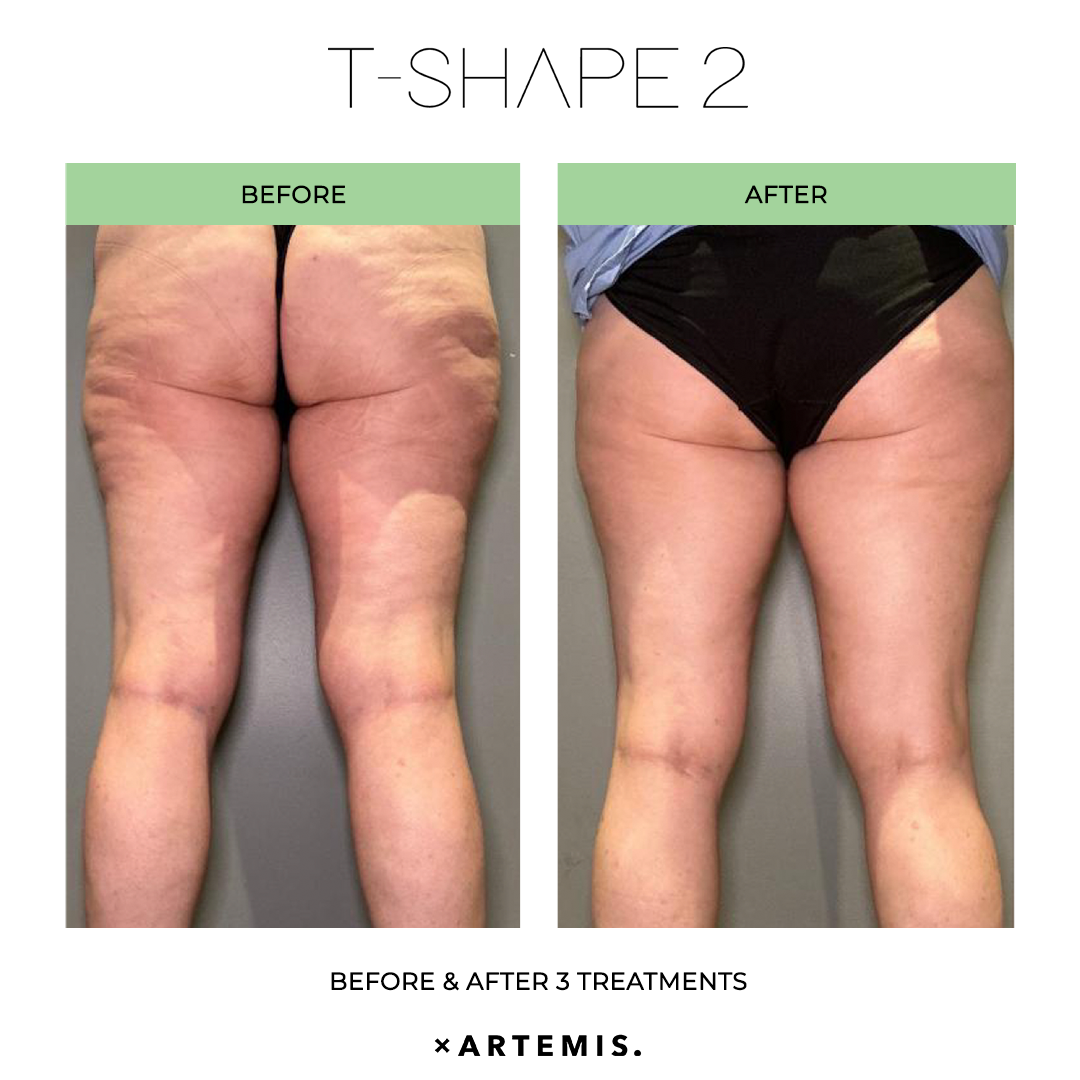 TShape2-SlimContour-09