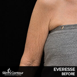 Everesse - Arm Before