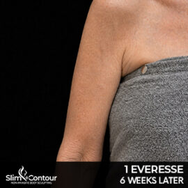 Everesse - Arm After